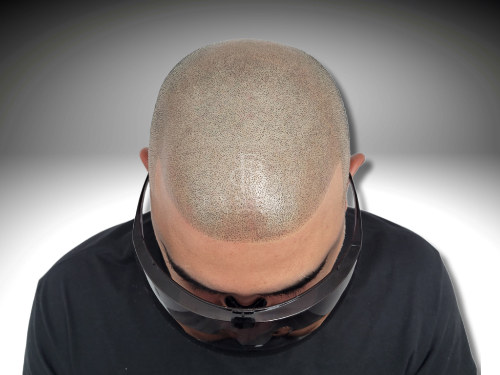 After alopecia coverage scalp micropigmentation result — Edison NJ
