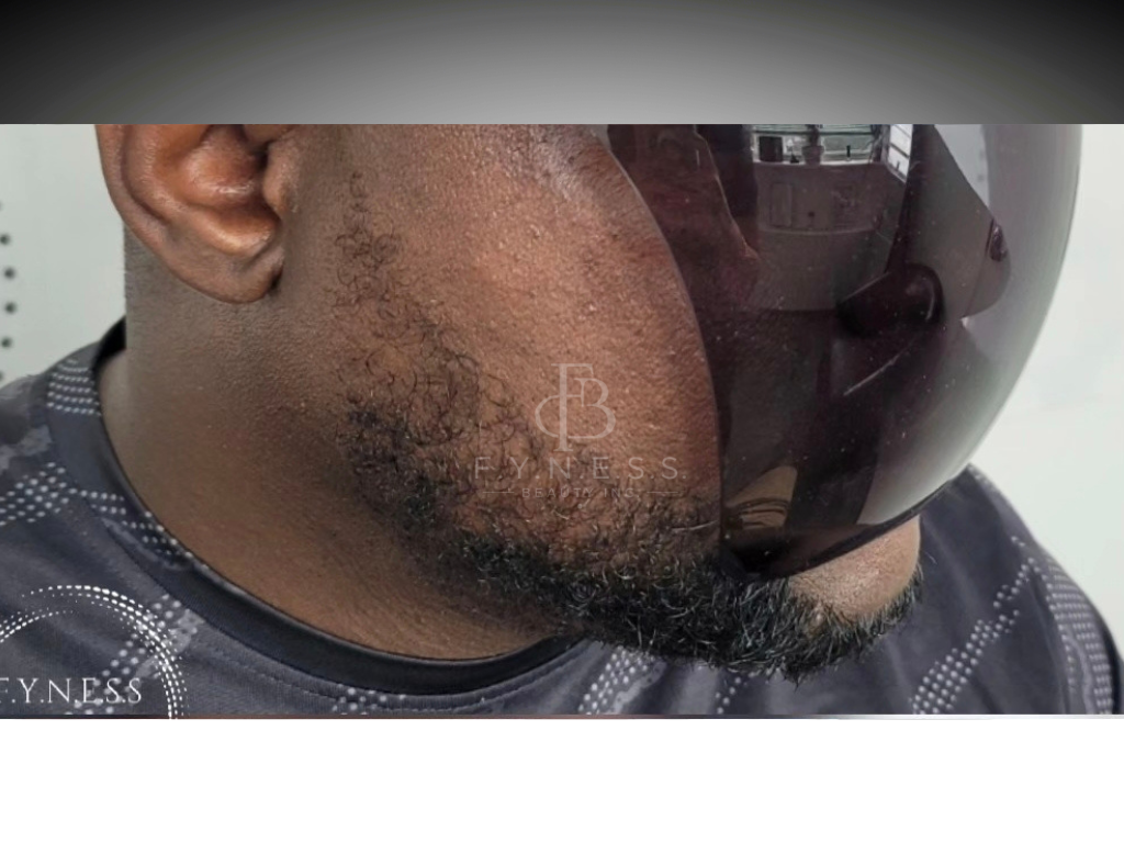 Before beard micropigmentation treatment — Edison NJ