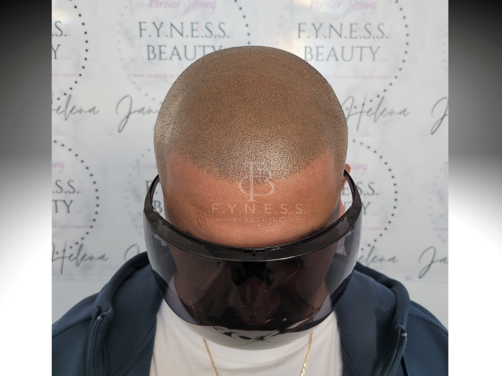 After hair density enhancement scalp micropigmentation — Edison NJ