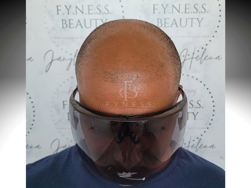 Before hair density enhancement scalp micropigmentation — Edison NJ